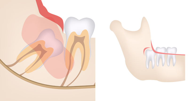 Dents de sagesse