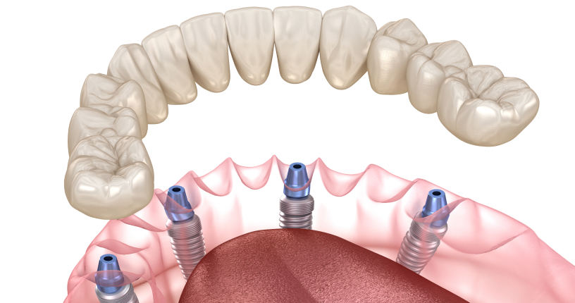 Implants multiples (All-on 4/6)