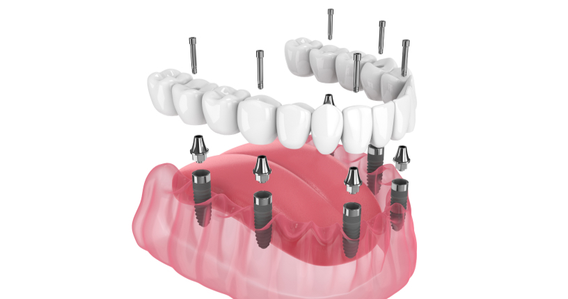 Implants multiples (All-on 4/6)