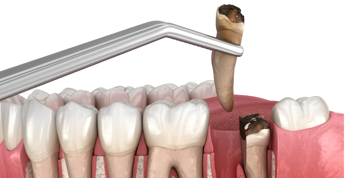 Extraction complexe dentaire du Dr Tourot Paris