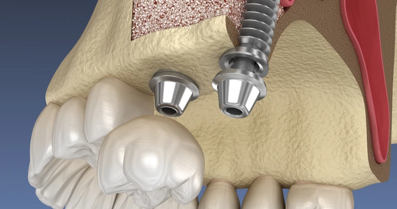 La greffe de sinus (Sinus lift)