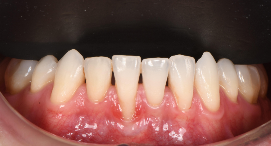 Greffe de gencive à Paris – Traitement des récessions gingivales