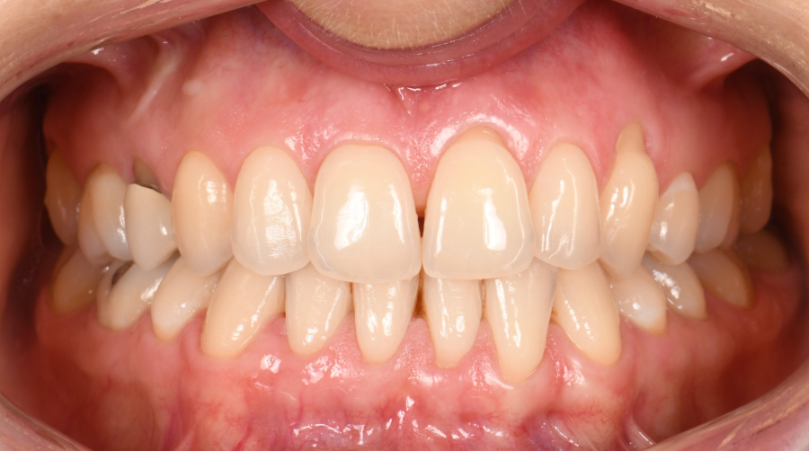 Greffe de gencive à Paris – Traitement des récessions gingivales