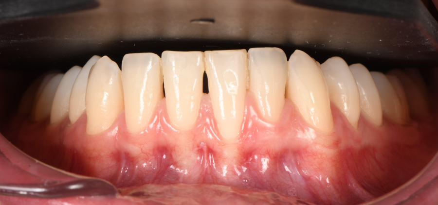 Greffe de gencive à Paris – Traitement des récessions gingivales