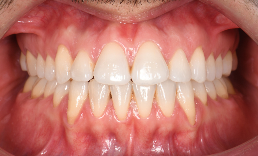 Greffe de gencive à Paris – Traitement des récessions gingivales