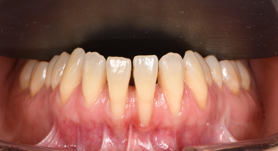 Greffe de gencive à Paris – Traitement des récessions gingivales