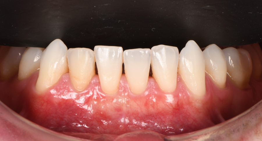 Greffe de gencive à Paris – Traitement des récessions gingivales