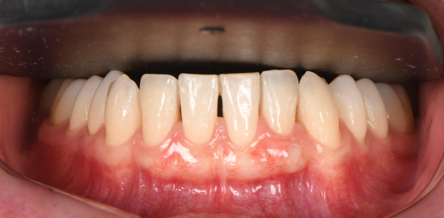 Greffe de gencive à Paris – Traitement des récessions gingivales