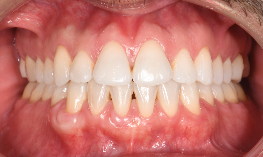 Greffe de gencive à Paris – Traitement des récessions gingivales
